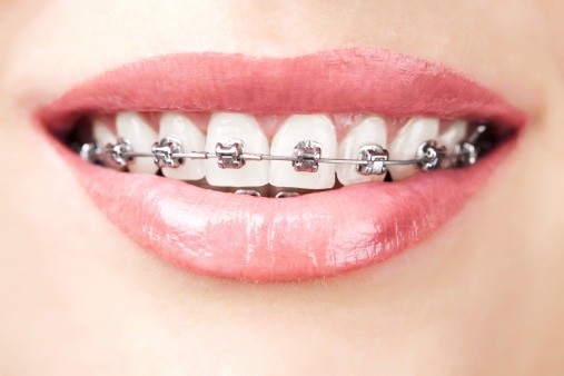 Orthodontics-Pic