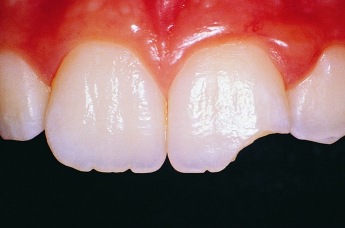 Dental Trauma-imh