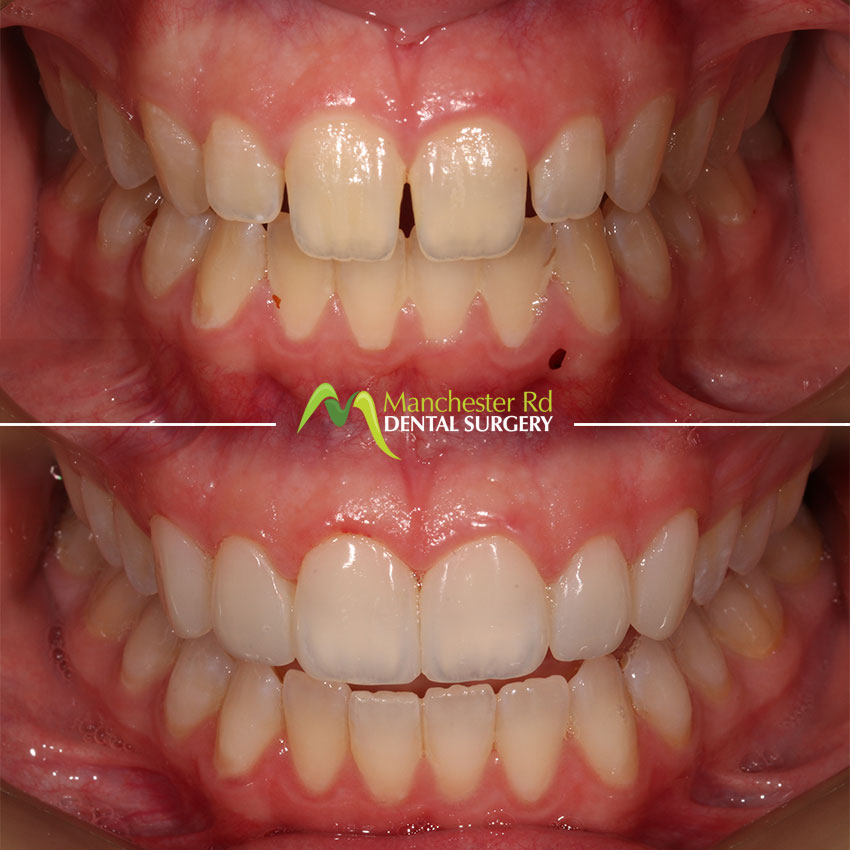 Composite Bonding 2 | Before & After | Manchester Rd Dental Surgery