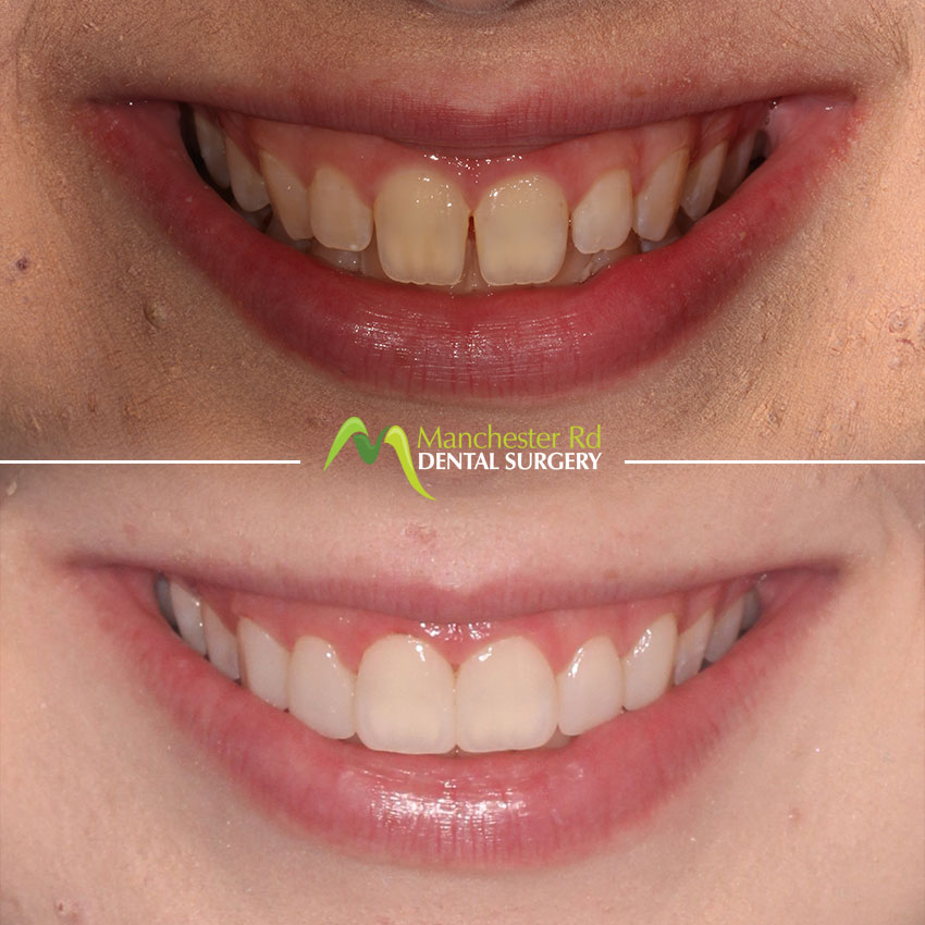 Composite Bonding 3 | Before & After | Manchester Rd Dental Surgery
