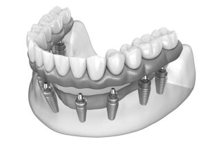 all on x implant model greyscale
